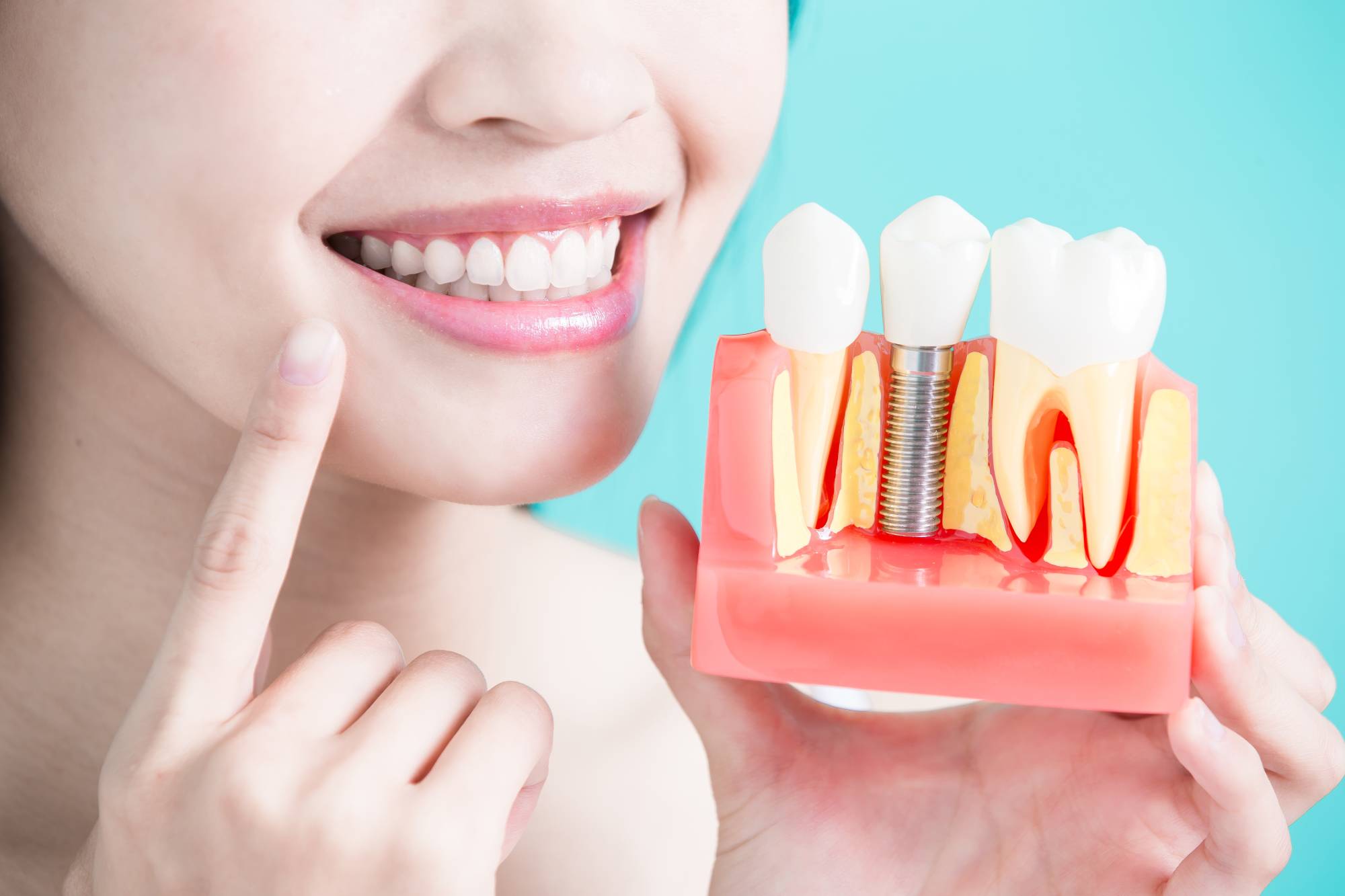 caring for dental implants
