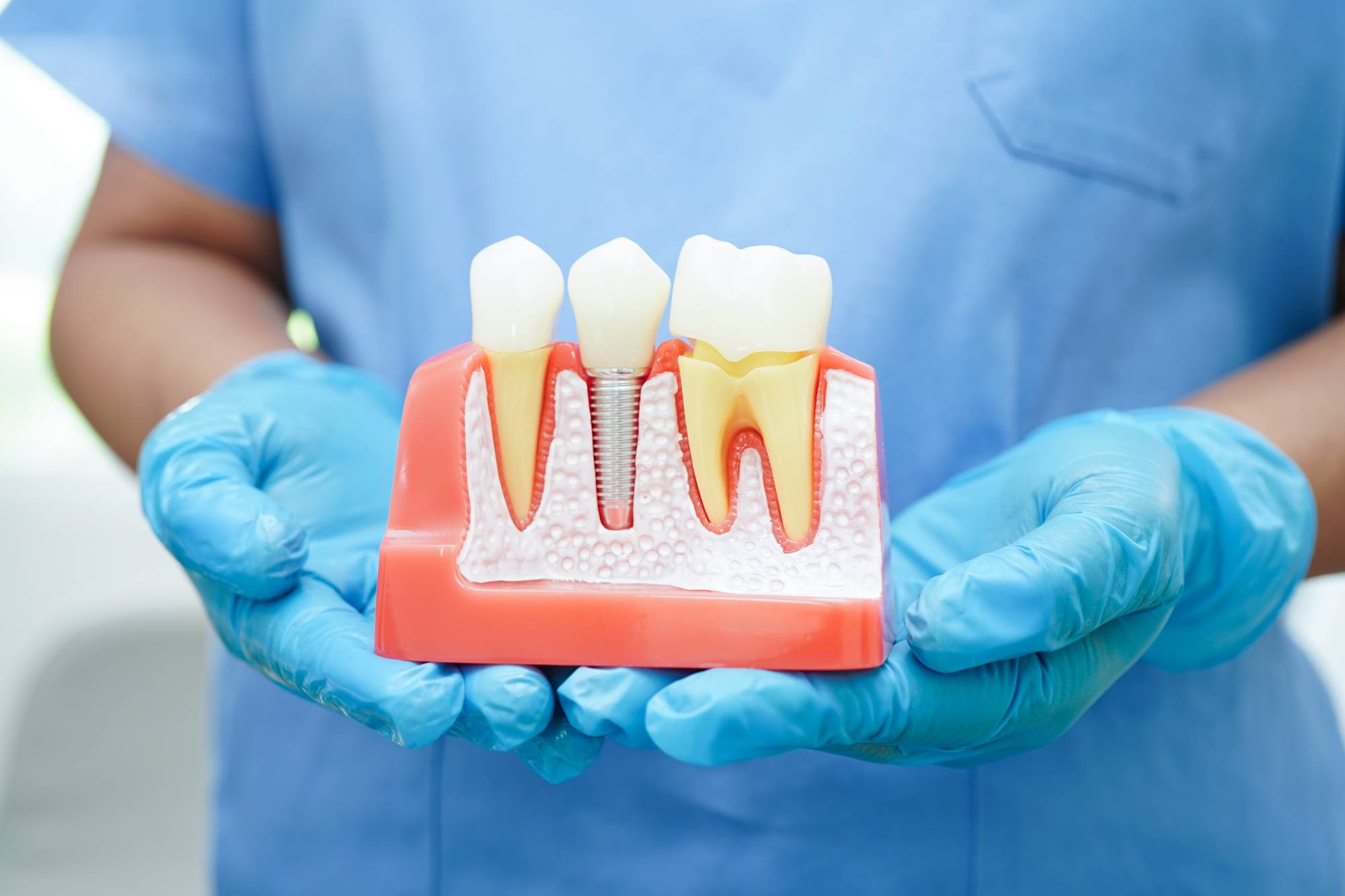 dental implants procedure