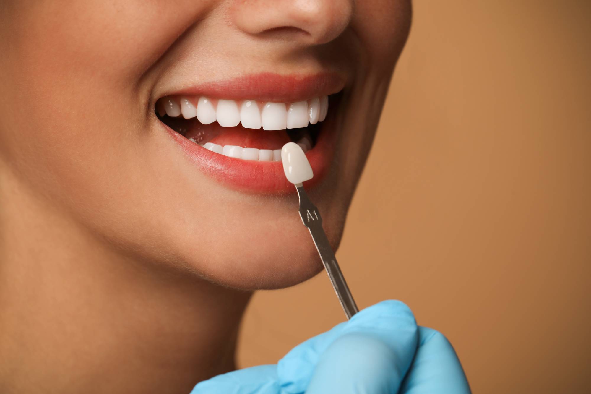Cost of Dental Veneers