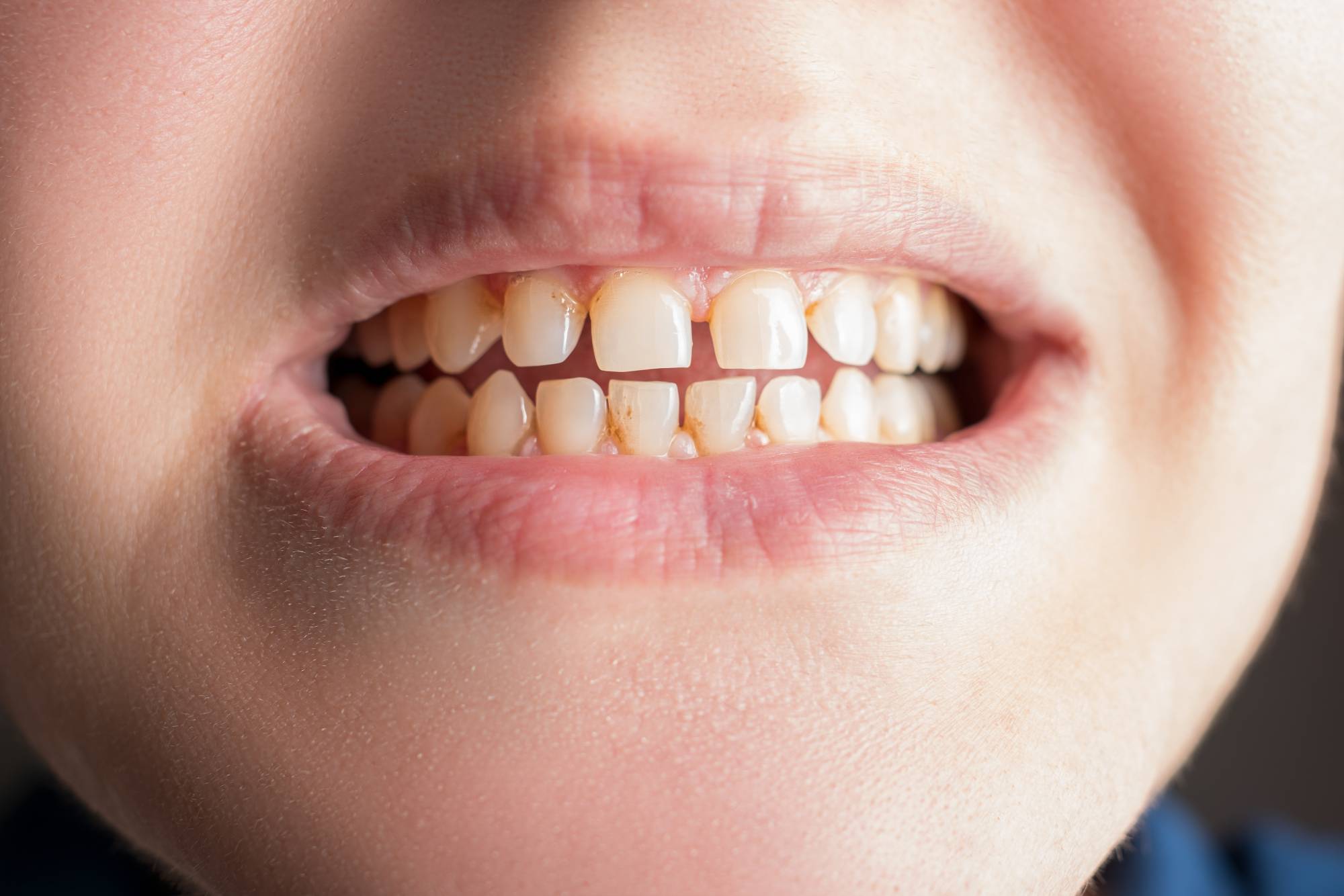 Large Fillings vs. Dental Crowns