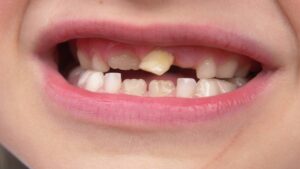 broken tooth guide