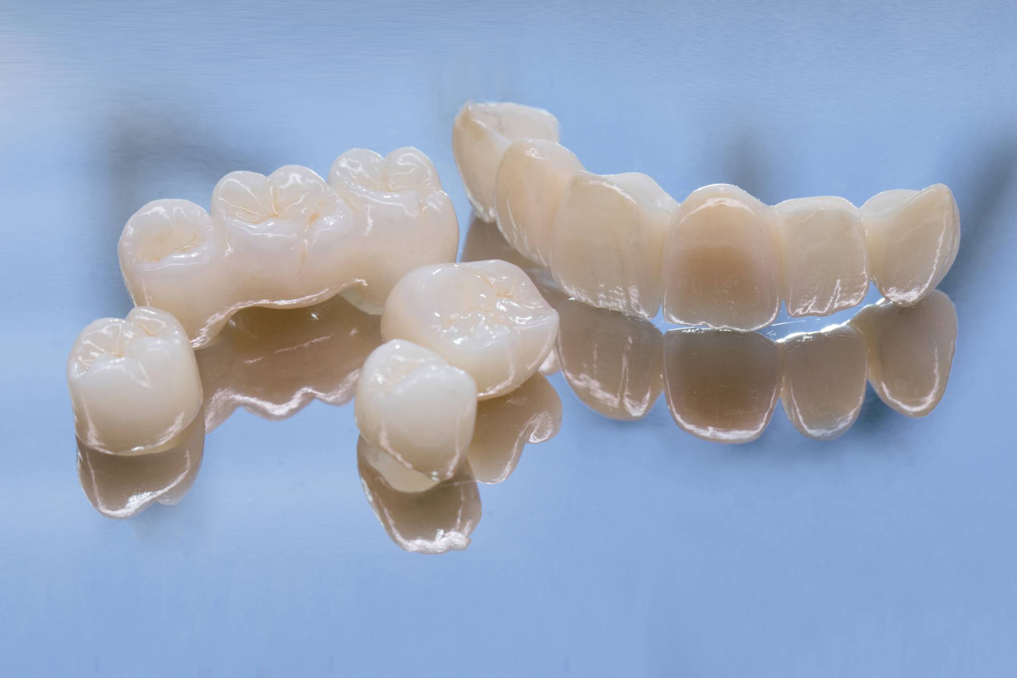 dental implants vs bridges