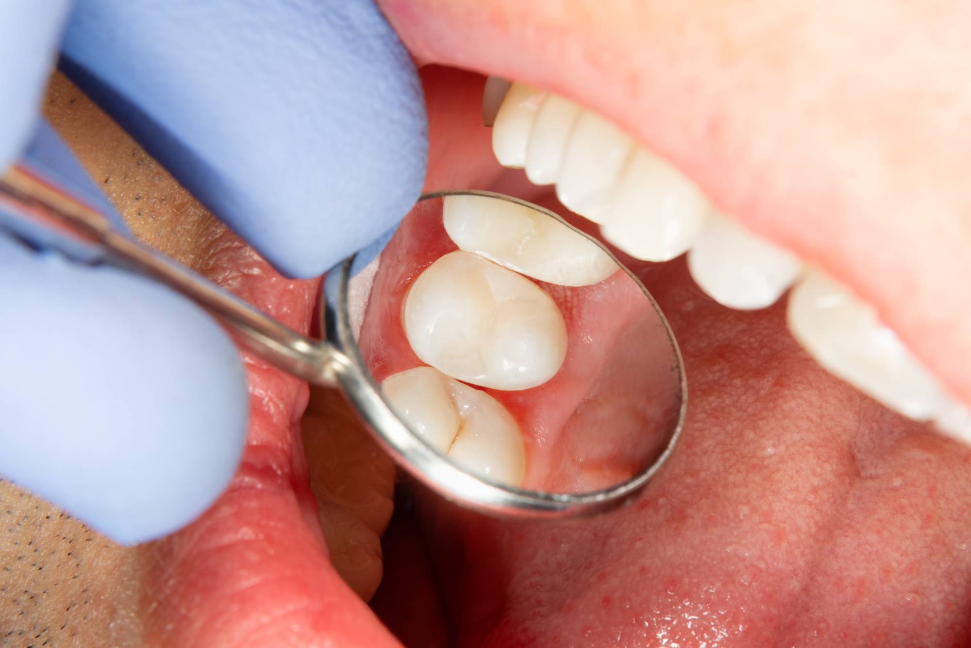 preventing tooth decay
